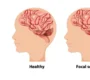 best neurologist in Faridabad for epilepsy treatment 90x80