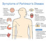 PARKINSON SYMPTOMS AND DIAGNOSIS 90x80
