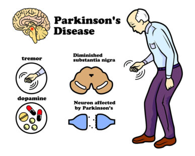 Parkinson’s Disease: Early Symptoms, Causes & Treatment