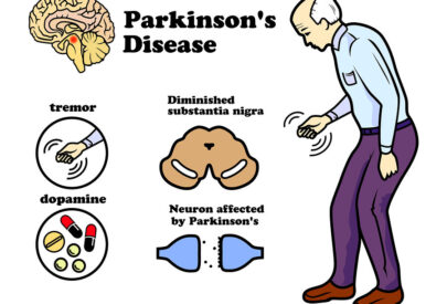Parkinson’s Disease: Early Symptoms, Causes & Treatment