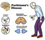 parkinson disease 90x80
