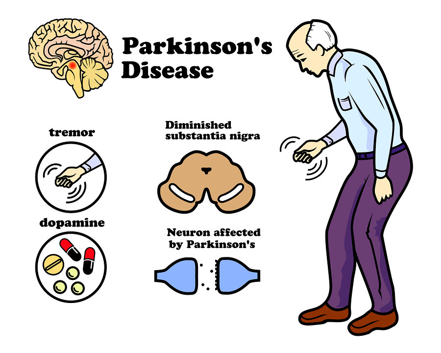 Parkinson’s Disease: Early Symptoms, Causes & Treatment